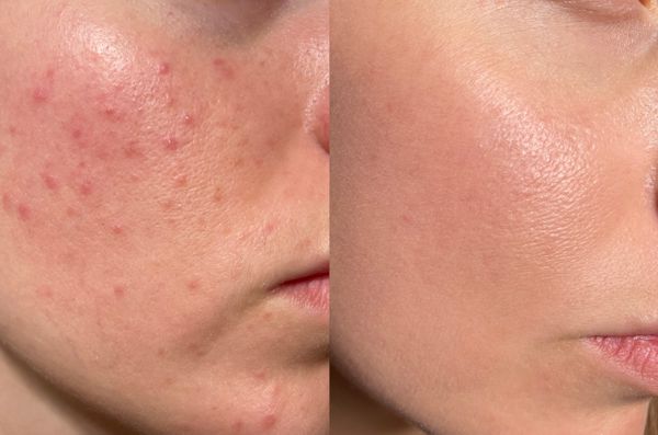 LED light therapy before and after results showing improved skin glow